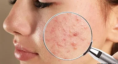 Sivilce Nedir? Nasıl Geçer? Evde Sivilce Maskesi Nasıl Yapılır?